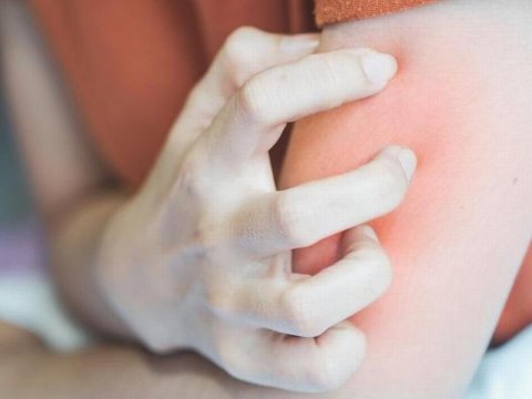 Een allergische reactie na een insectenbeet, wat nu?  